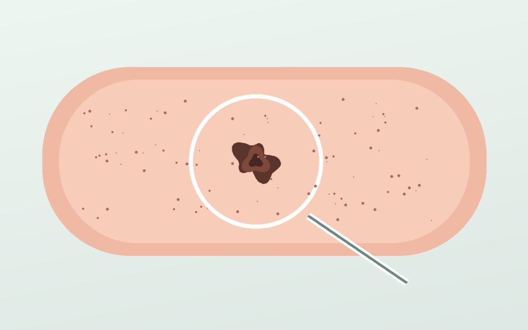 Cáncer de piel y su sentido biológico. Ectodermo