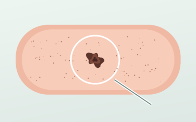 Cáncer de piel y su sentido biológico. Ectodermo